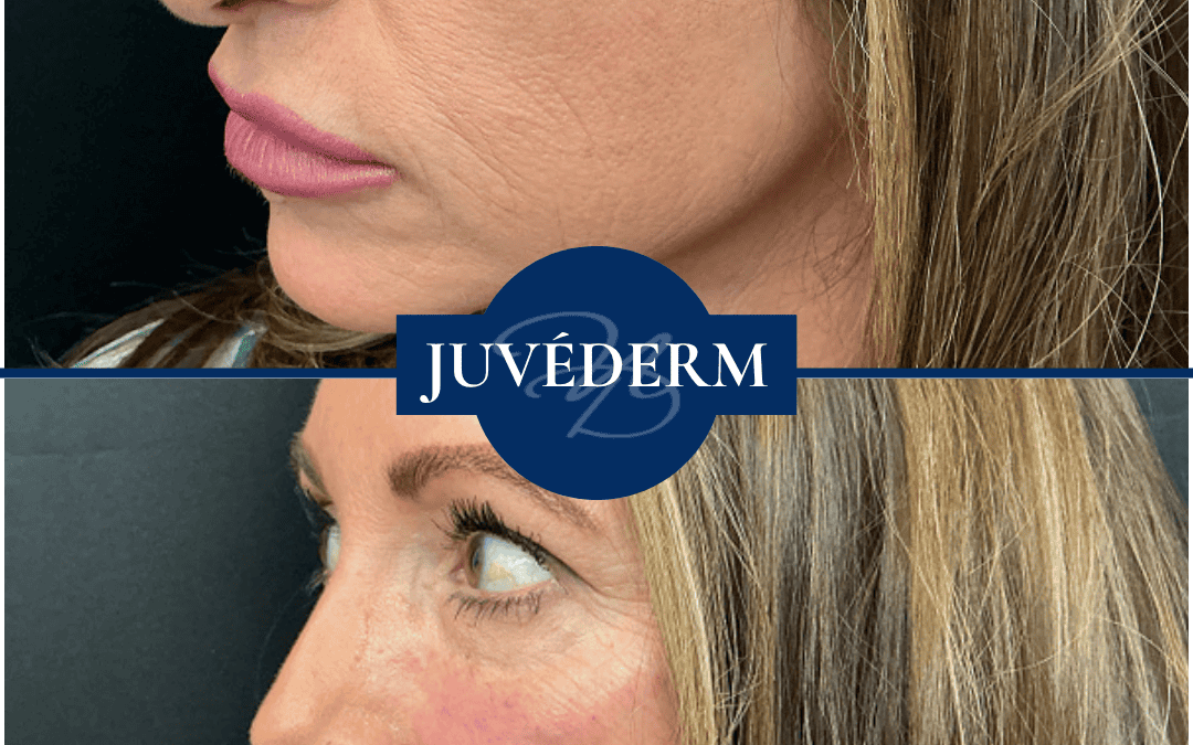 Fillers In Hammond Louisiana