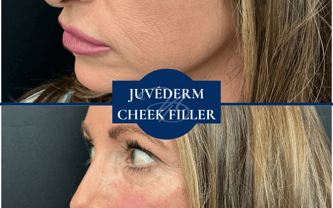 Medical Spa In Hammond Louisiana Juvederm Cheek Filler Before After 005