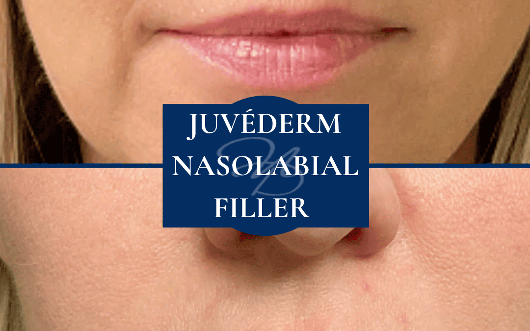 Medical Spa In Hammond Louisiana Juvederm Nasolabial Filler Before After 006