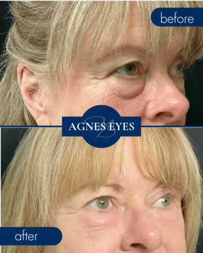 AGNES Before After 001