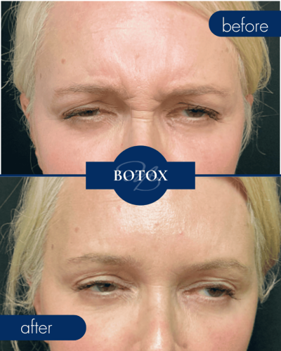 Botox Before After 001