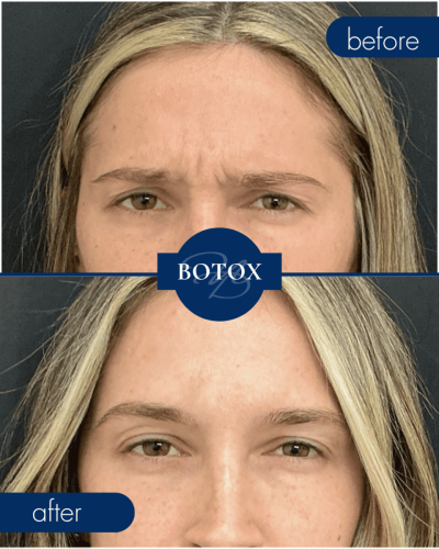 Botox Before After 002