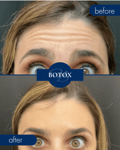 Botox Before After 003