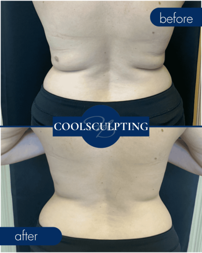 Cool Sculpting Before After 001