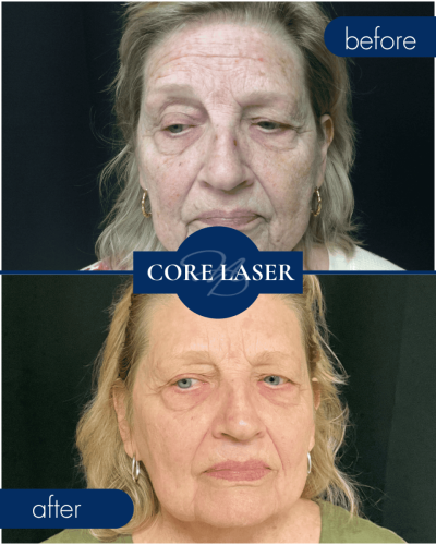 Core Laser Before After 001