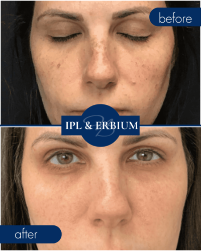 Laser Before After 001