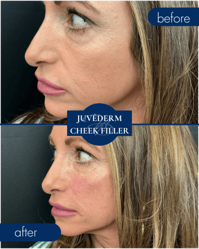 Medical Spa In Hammond Louisiana Juvederm Cheek Filler Before After 005