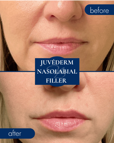 Medical Spa In Hammond Louisiana Juvederm Nasolabial Filler Before After 006