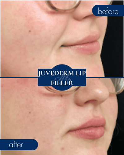 Medical Spa In Hammond Lousiana Juvederm Lip Filler Before After 001