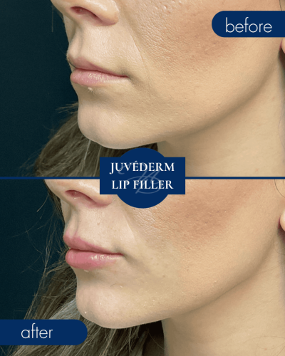 Medical Spa In Hammond Lousiana Juvederm Lip Filler Before After 002