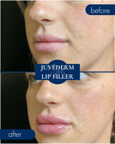 Medical Spa In Hammond Lousiana Juvederm Lip Filler Before After 003
