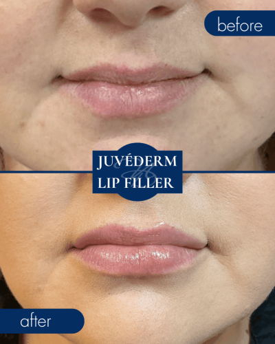 Medical Spa In Hammond Lousiana Juvederm Lip Filler Before After 004