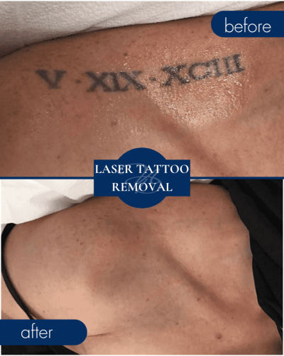 Medical Spa In Hammond Lousiana Laser Tattoo Removal Before After 001