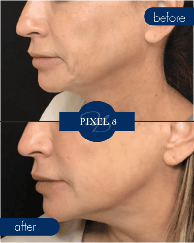 Pixel8 Before After 001