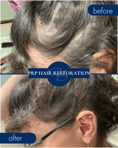 Prp Before After 001