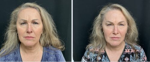 Medical-Dermatology-in-Madisonville-Louisiana-03-05-26-botox-002