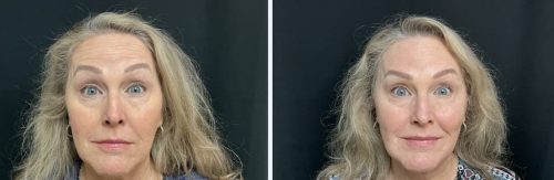 Medical-Dermatology-in-Madisonville-Louisiana-03-05-26-botox-003