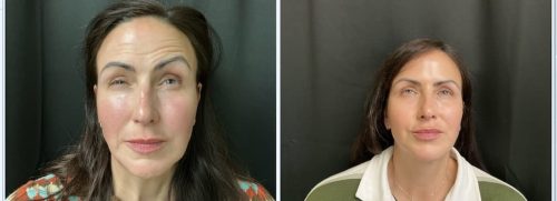 Medical-Dermatology-in-Madisonville-Louisiana-03-05-26-botox-004