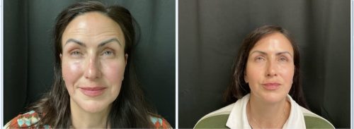 Medical-Dermatology-in-Madisonville-Louisiana-03-05-26-botox-005