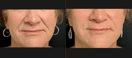 Medical-Dermatology-in-Madisonville-Louisiana-03-05-26-juvederm-filler-003
