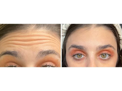 Medical-Dermatology-in-Madisonville-Louisiana-03-13-26-botox-001