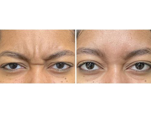 Medical-Dermatology-in-Madisonville-Louisiana-03-13-26-botox-002