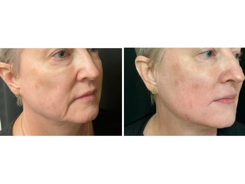 Medical-Dermatology-in-Madisonville-Louisiana-03-13-26-dermaprp-filler-001