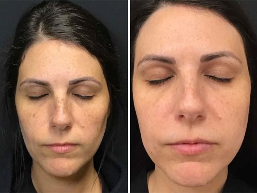 Medical-Dermatology-in-Madisonville-Louisiana-03-13-26-ipl-fotofacial-001